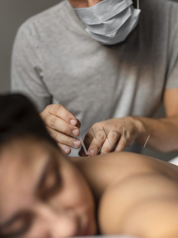 close-up-therapist-doing-acupuncture